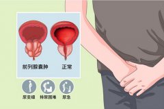 前列腺囊肿怎么办